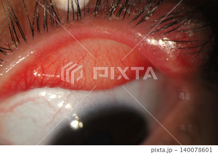 Upper eyelid eversion demonstrating an acute hordeolum with eyelash crusting and conjunctival hyperemia 140078601
