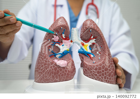Pneumonia, lung cancer, Asian doctor with human lung model. Pneumonia, lung cancer, Asian doctor with human lung model. 140092772