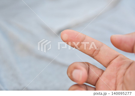 Close-up of a small water blister on a person's index finger caused by a burn or friction. Concept of skin injury, first aid, dermatology, and minor domestic accident on blurred background. Close-up of a small water blister on a person's index finger caused by a burn or friction. Concept of skin injury, first aid, dermatology, and minor domestic accident on blurred background. 140095277