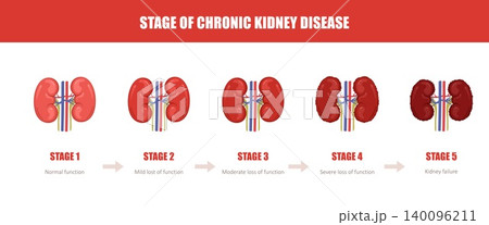 Chronic kidney disease. Renal failure treatment. Medical care or therapy concept. Anatomy vector illustration Chronic kidney disease. Renal failure treatment. Medical care or therapy concept. Anatomy vector illustration 140096211