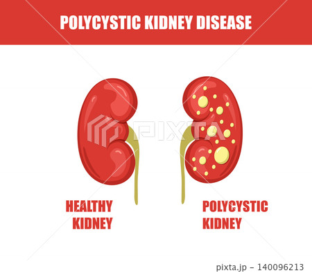Polycystic kidney disease. Renal treatment or ultrasound diagnosis. Health care concept. Vector illustration in flat cartoon style 140096213