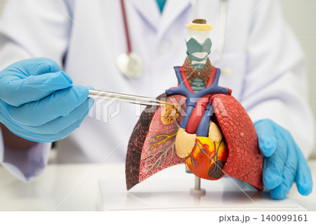 Pneumonia, lung cancer, Asian doctor holding human anatomy model for study diagnosis and treatment in hospital. 140099161