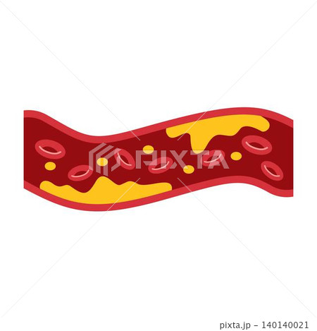 artery with cholesterol blocked in blood vessel illustration artery with cholesterol blocked in blood vessel illustration 140140021