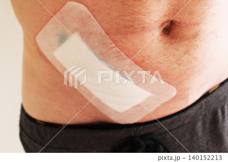A large plaster on the man's abdomen. Consequences of appendicitis A large plaster on the man's abdomen. Consequences of appendicitis 140152213