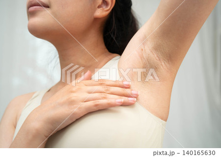 Asian woman have problem black armpit beauty skin care. 140165630