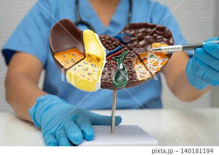 Cirrhosis, Liver cancer, fatty liver, Asian woman with liver human anatomy model. Cirrhosis, Liver cancer, fatty liver, Asian woman with liver human anatomy model. 140181194