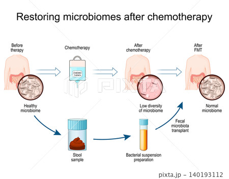 Restoring microbiomes after chemotherapy. Human body and gut microbiota Before and After chemotherapy and FMT therapy. Restoring microbiomes after chemotherapy. Human body and gut microbiota Before and After chemotherapy and FMT therapy. 140193112