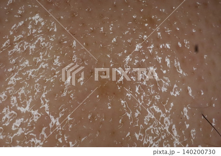 Close-up of Skin with Dandruff Flakes 140200730