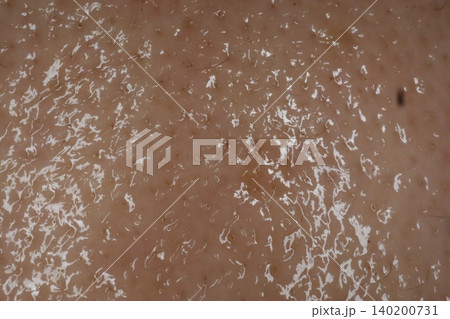 Close-up of Dry Skin with Flakes Close-up of Dry Skin with Flakes 140200731