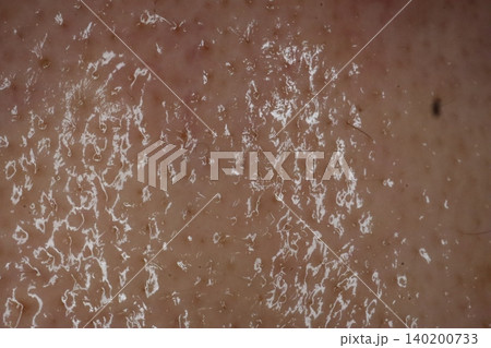 Close-up of Dry Skin with Flakes 140200733