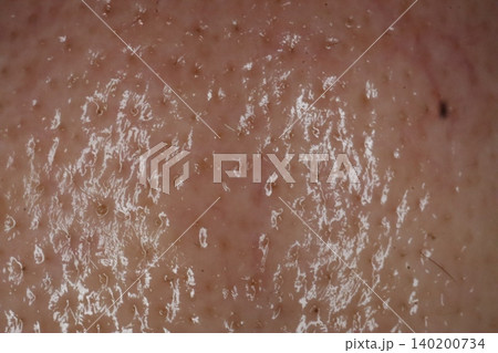 Close-up of Human Skin Texture with Flakes 140200734