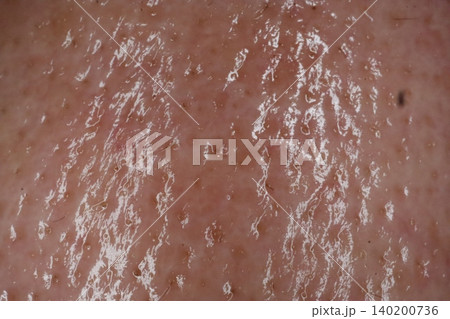 Dry Skin Texture with White Flakes 140200736