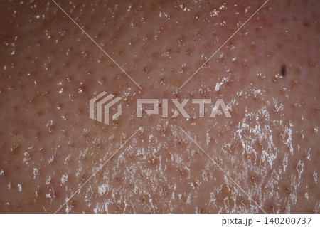 Close-up of Human Skin Texture with Pores and Oil Close-up of Human Skin Texture with Pores and Oil 140200737