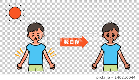 An illustration illustrating the passage of time due to sunburn. An illustration illustrating the passage of time due to sunburn. 140210044
