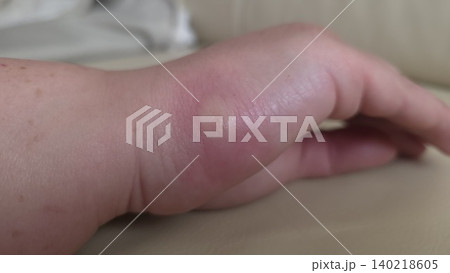 Close-up of swollen red insect bite with blister on caucasian human hand against blurred beige background. Concept of allergic reaction and healthcare Close-up of swollen red insect bite with blister on caucasian human hand against blurred beige background. Concept of allergic reaction and healthcare 140218605