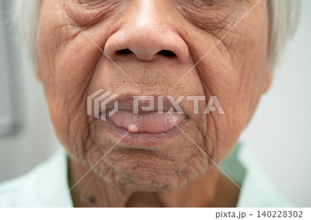 Cysts at the tongue in mouth of Asian elderly old lady woman patient. Cysts at the tongue in mouth of Asian elderly old lady woman patient. 140228302