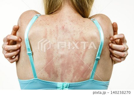 Woman scratching her itchy back with allergy rash Woman scratching her itchy back with allergy rash 140238270