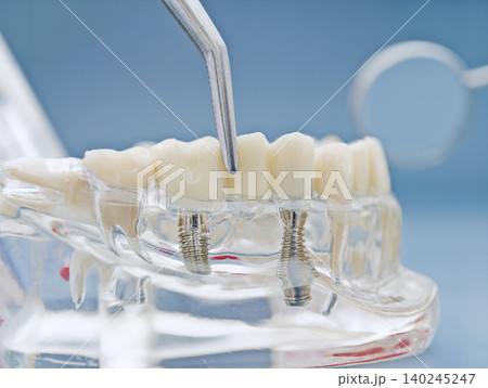Dental implantology concept. Tweezers placing a ceramic dental bridge on titanium screw implants in a transparent jaw model. Dental implantology concept. Tweezers placing a ceramic dental bridge on titanium screw implants in a transparent jaw model. 140245247