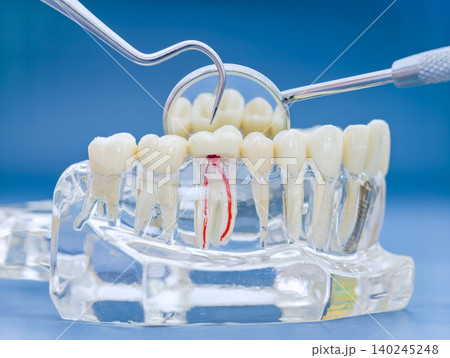 Endodontics and root canal treatment concept. Transparent dental model showing red tooth nerve with explorer and mirror. Endodontics and root canal treatment concept. Transparent dental model showing red tooth nerve with explorer and mirror. 140245248