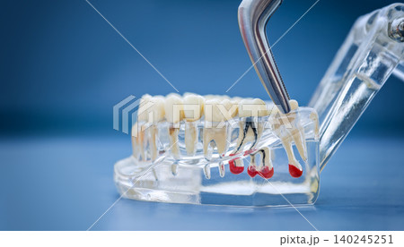 Transparent dental teaching model of the jaw with tooth pathologies, cysts, and surgical forceps on a blue background. Tooth extraction concept. Transparent dental teaching model of the jaw with tooth pathologies, cysts, and surgical forceps on a blue background. Tooth extraction concept. 140245251