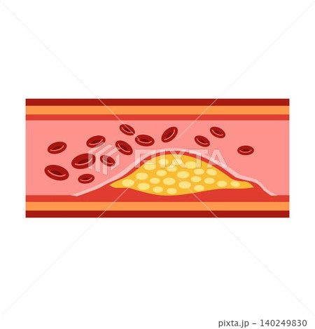cholesterol in artery and fat in the blood vessels cholesterol in artery and fat in the blood vessels 140249830