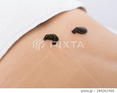 patient during leech therapy, alternative Hirudotherapy, blood purification patient during leech therapy, alternative Hirudotherapy, blood purification 140262369