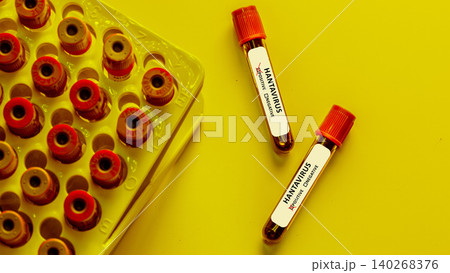 Laboratory samples show hantavirus testing in a scientific research setting Laboratory samples show hantavirus testing in a scientific research setting 140268376