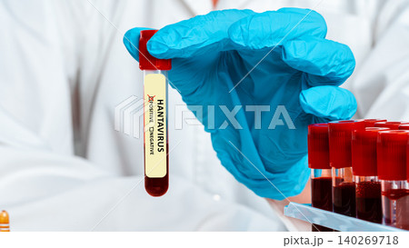 Laboratory test shows positive result for hantavirus in blood sample Laboratory test shows positive result for hantavirus in blood sample 140269718