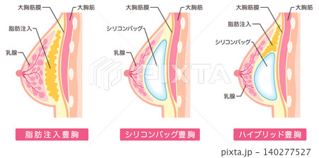 豊胸手術の種類 美容整形 胸 豊胸手術の種類 美容整形 胸 140277527