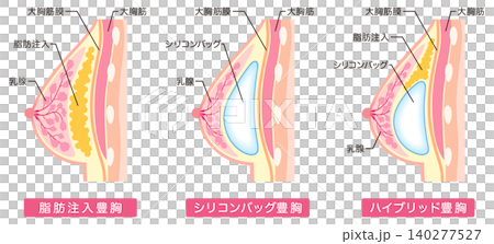 豊胸手術の種類 美容整形 胸 豊胸手術の種類 美容整形 胸 140277527