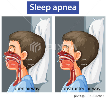 Comparison of Open and Obstructed Airway in Sleep Apnea 140282843