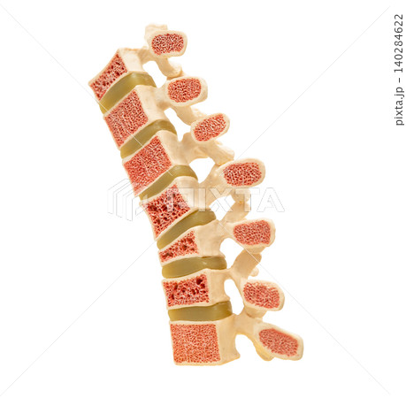 osteoporosis in back bone model isolated on white background with clipping path. osteoporosis in back bone model isolated on white background with clipping path. 140284622