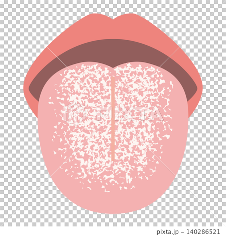 White tongue (tongue coating) White tongue (tongue coating) 140286521