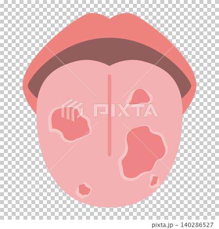 Spotted tongue (geographic tongue) Spotted tongue (geographic tongue) 140286527