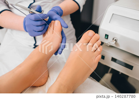 laser treatment on toenail, fungal infection on the toenails 140287780