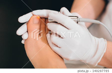 laser treatment on toenail, fungal infection on the toenails 140287785