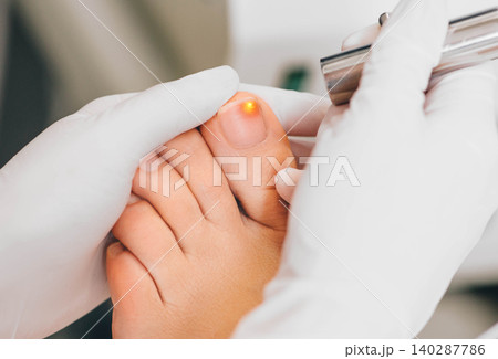 laser treatment on toenail, fungal infection on the toenails 140287786