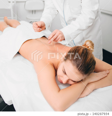 Client having acupuncture treatment on her back Client having acupuncture treatment on her back 140287934