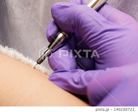 Mole removal on human body with medical radio wave laser by electrocoagulation method, macro Mole removal on human body with medical radio wave laser by electrocoagulation method, macro 140288721