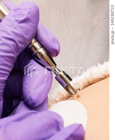 Mole removal on human body with medical contactless laser, close-up Mole removal on human body with medical contactless laser, close-up 140288722