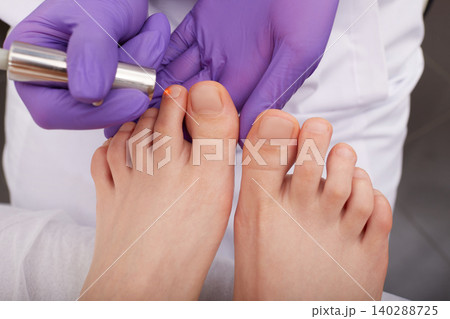 Laser treatment of onychomycosis for woman's foot toenail, close-up. Laser treatment fungal infection on toenail Laser treatment of onychomycosis for woman's foot toenail, close-up. Laser treatment fungal infection on toenail 140288725