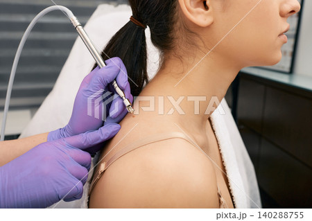 Woman having mole removal in medical center using non-contact laser. Painless removal of moles and papillomas on human skin Woman having mole removal in medical center using non-contact laser. Painless removal of moles and papillomas on human skin 140288755
