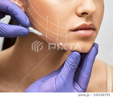 Facial lifting thread. Thread facelift with arrows on face for woman's skin, procedure facial contouring using mesothreads 140288795