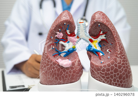 Pneumonia, lung cancer, Asian doctor with human lung model. Pneumonia, lung cancer, Asian doctor with human lung model. 140296078