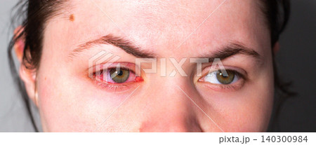 Red eye due to viral or bacterial infection. Eye doctor examining inflamed conjunctiva. Medical clinic photography for health articles Red eye due to viral or bacterial infection. Eye doctor examining inflamed conjunctiva. Medical clinic photography for health articles 140300984
