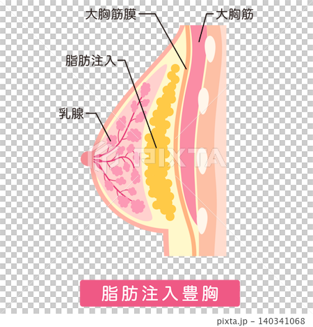 自體脂肪隆乳;隆乳手術類型;整形手術;乳房 自體脂肪隆乳;隆乳手術類型;整形手術;乳房 140341068