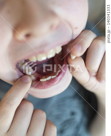 A 10-year-old boy shows a fresh empty socket in his lower jaw after losing a baby tooth. He holds the shed milk tooth in his hand, highlighting natural childhood development and dental growth. A 10-year-old boy shows a fresh empty socket in his lower jaw after losing a baby tooth. He holds the shed milk tooth in his hand, highlighting natural childhood development and dental growth. 140341333