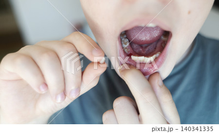 A 10-year-old boy shows a fresh empty socket in his lower jaw after losing a baby tooth. He holds the shed milk tooth in his hand, highlighting natural childhood development and dental growth. A 10-year-old boy shows a fresh empty socket in his lower jaw after losing a baby tooth. He holds the shed milk tooth in his hand, highlighting natural childhood development and dental growth. 140341335