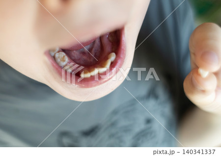 A 10-year-old boy shows a fresh empty socket in his lower jaw after losing a baby tooth. He holds the shed milk tooth in his hand, highlighting natural childhood development and dental growth. 140341337