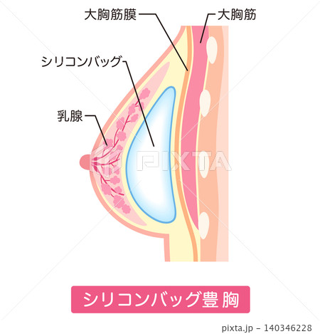 シリコンバッグ豊胸 豊胸手術の種類 美容整形 胸 シリコンバッグ豊胸 豊胸手術の種類 美容整形 胸 140346228